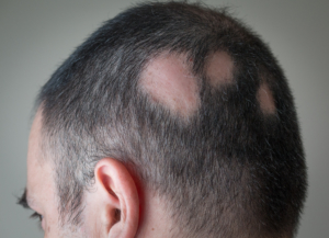 Kreisrunder Haarausfall Männer