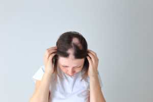 Kreisrunder Haarausfall Ursachen