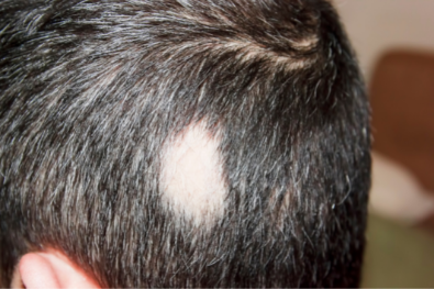 Woher kommt kreisrunder Haarausfall