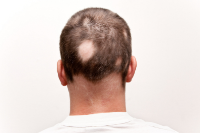Woher kommt kreisrunder Haarausfall