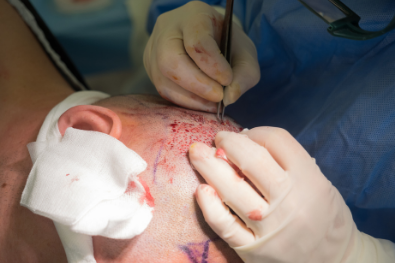Haartransplantation Methoden