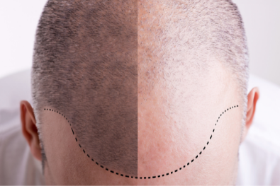 Haartransplantation Vorher-Nachher